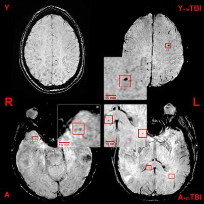 The Effect of Mild Traumatic Brain Injury on Cerebral Microbleeds in Aging